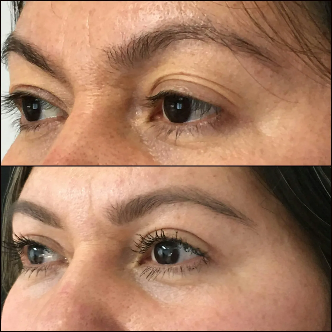 Antes e depois de blefaroplastia superior cirúrgica em Brasília: pálpebra caída corrigida e olhar mais aberto — Dr. Thiago Perfeito