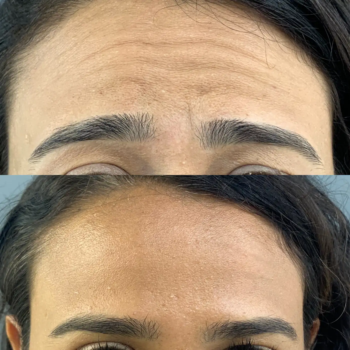 Antes e depois de toxina botulínica nas linhas horizontais da testa em Brasília — Dr. Thiago Perfeito