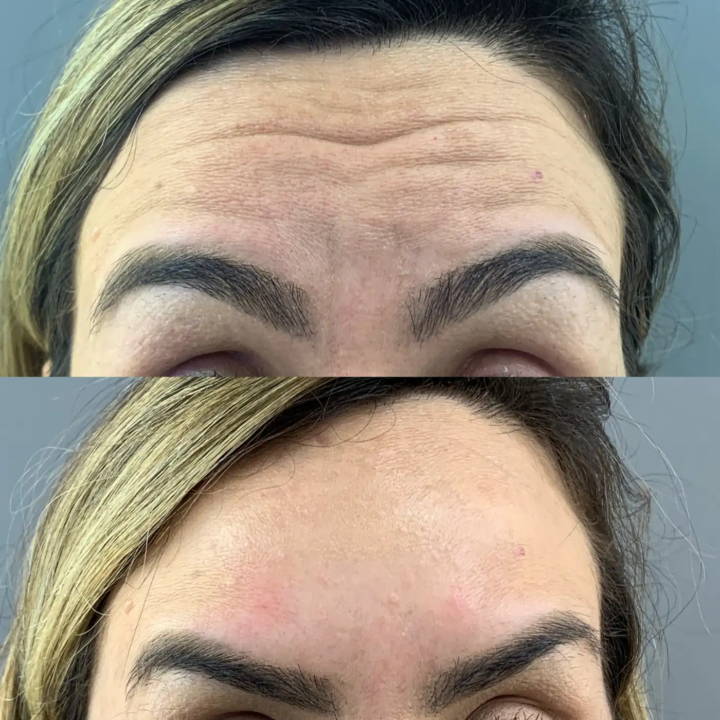 Antes e depois de botox na testa em Brasília — Dr. Thiago Perfeito