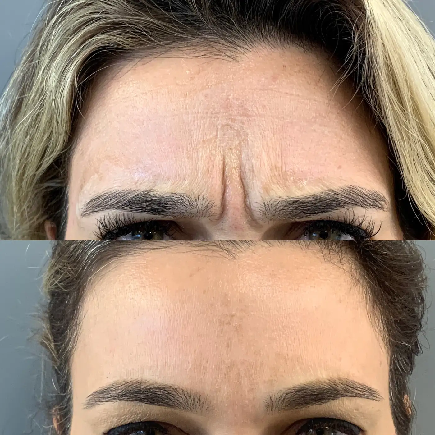 Antes e depois de Botox na testa e glabela em Brasília — Dr. Thiago Perfeito