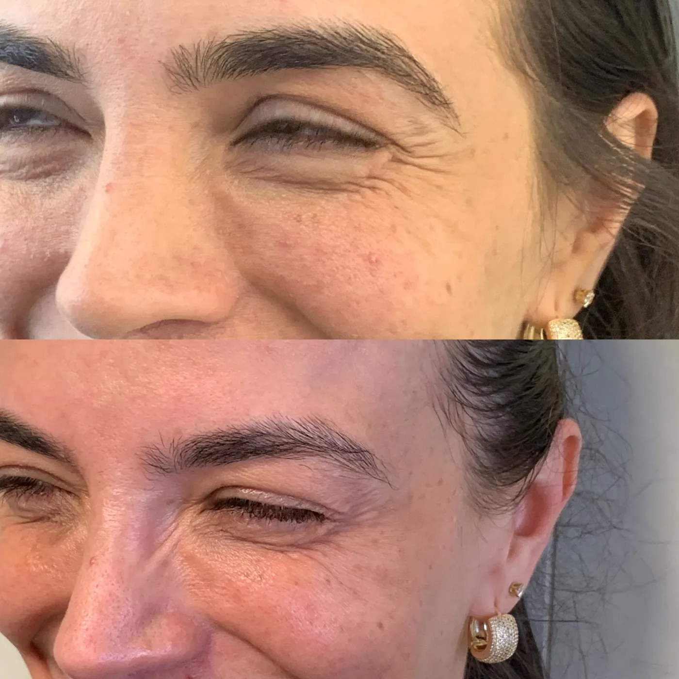 Antes e depois de botox nos pés de galinha em Brasília — Dr. Thiago Perfeito