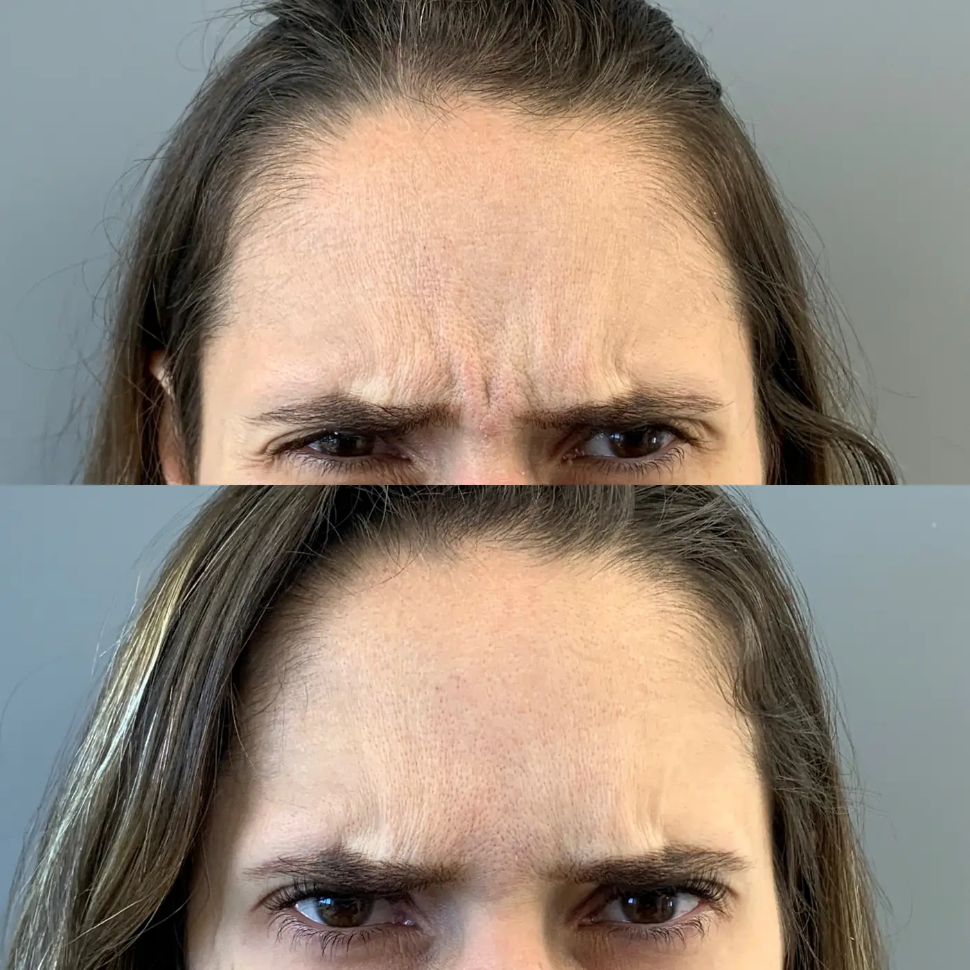 Antes e depois de botox na glabela e na testa em Brasília — Dr. Thiago Perfeito