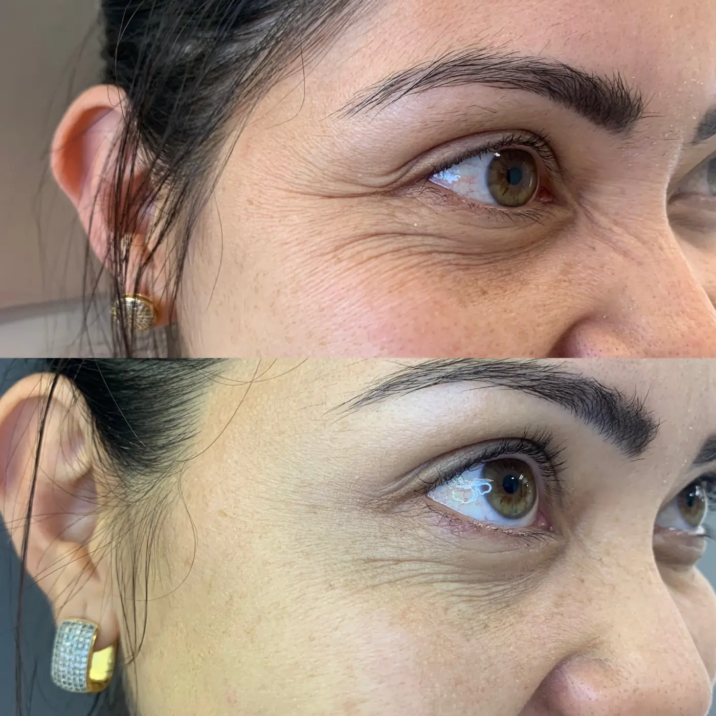 Antes e depois de toxina botulínica nos pés de galinha em Brasília — Dr. Thiago Perfeito