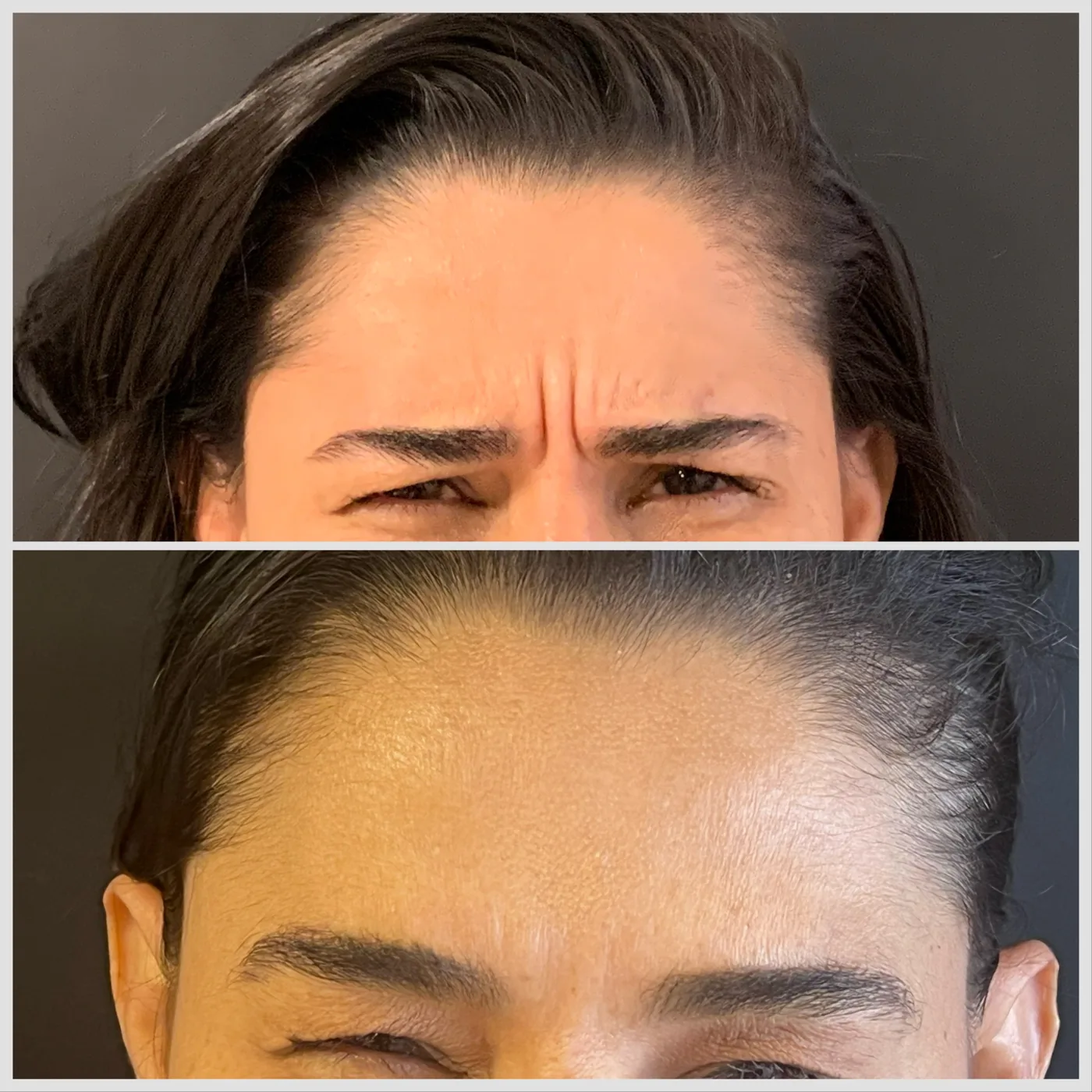 Antes e depois de Botox em Brasília — Dr. Thiago Perfeito