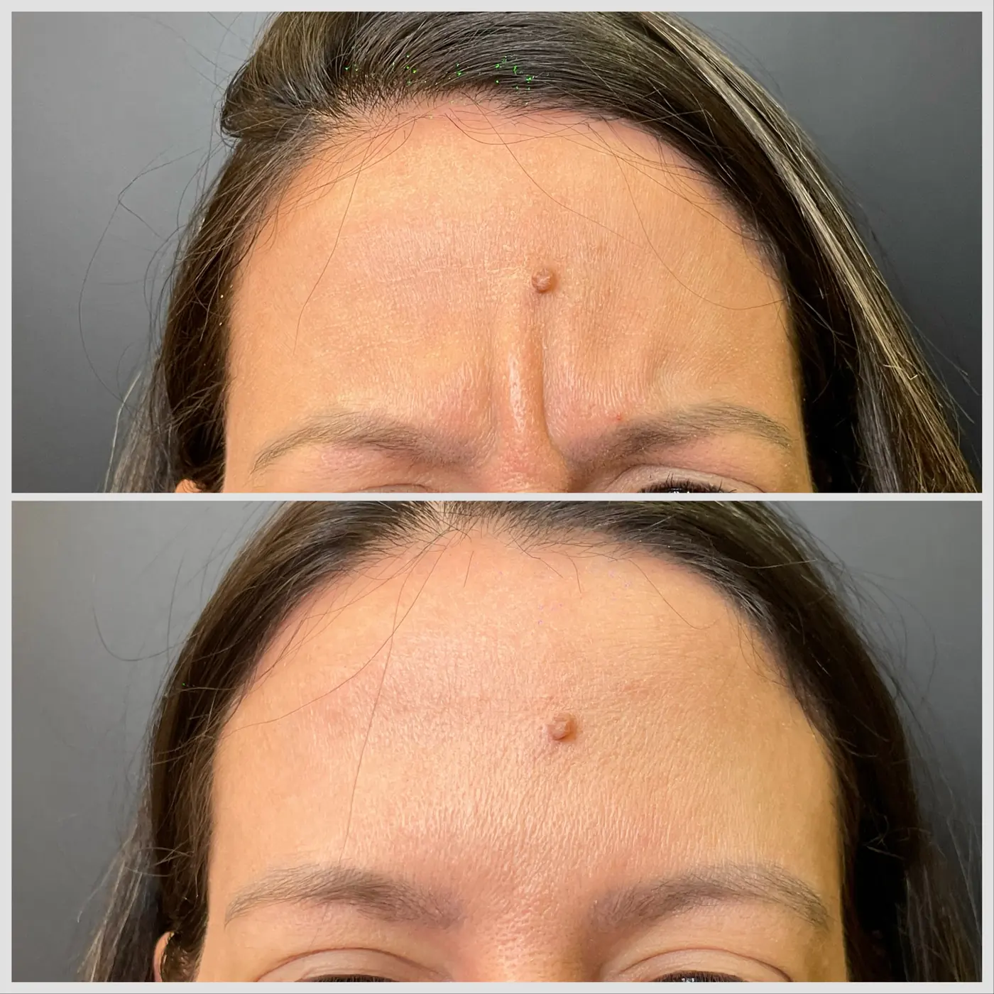 Antes e depois de Botox na glabela em Brasília — Dr. Thiago Perfeito