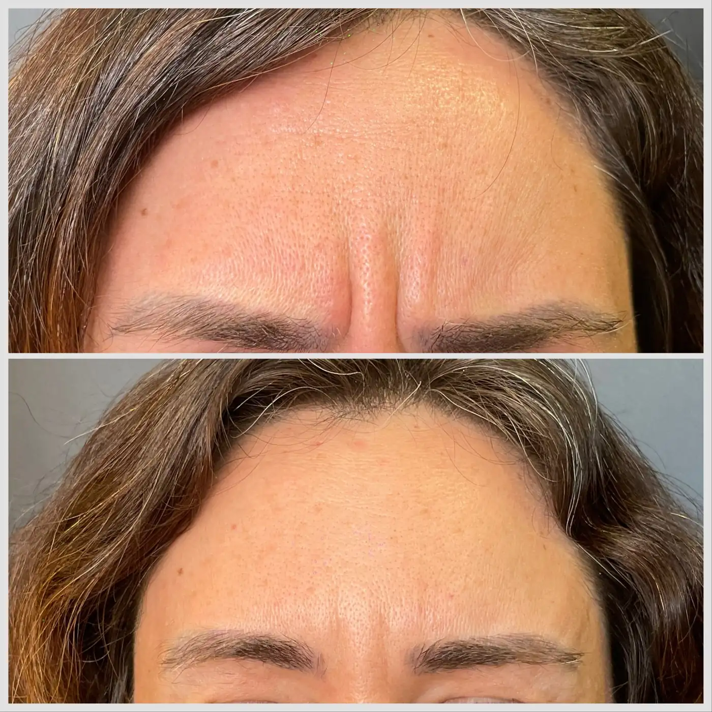 Antes e depois de toxina botulínica na glabela em Brasília — Dr. Thiago Perfeito
