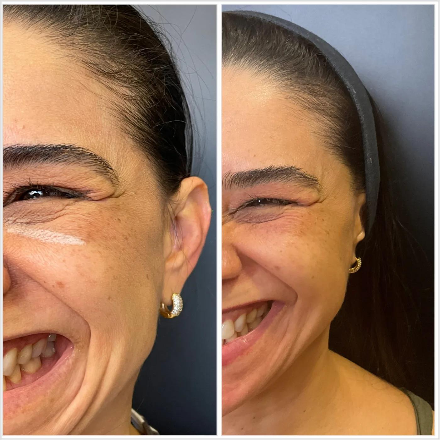 Antes e depois de Botox no canto dos olhos em Brasília — Dr. Thiago Perfeito