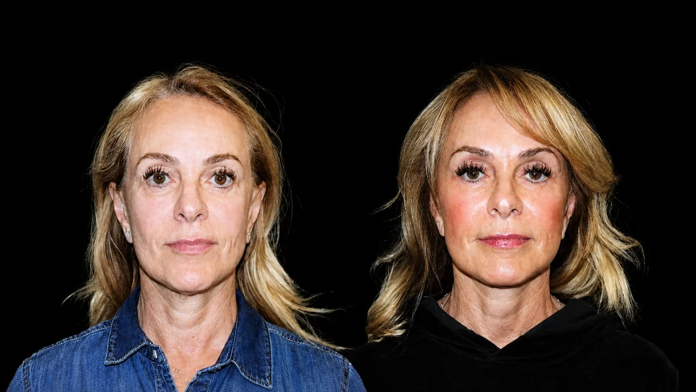 Antes e depois de Exocube em Brasília — melhora de qualidade de pele: luminosidade, textura e espessura. Dr. Thiago Perfeito