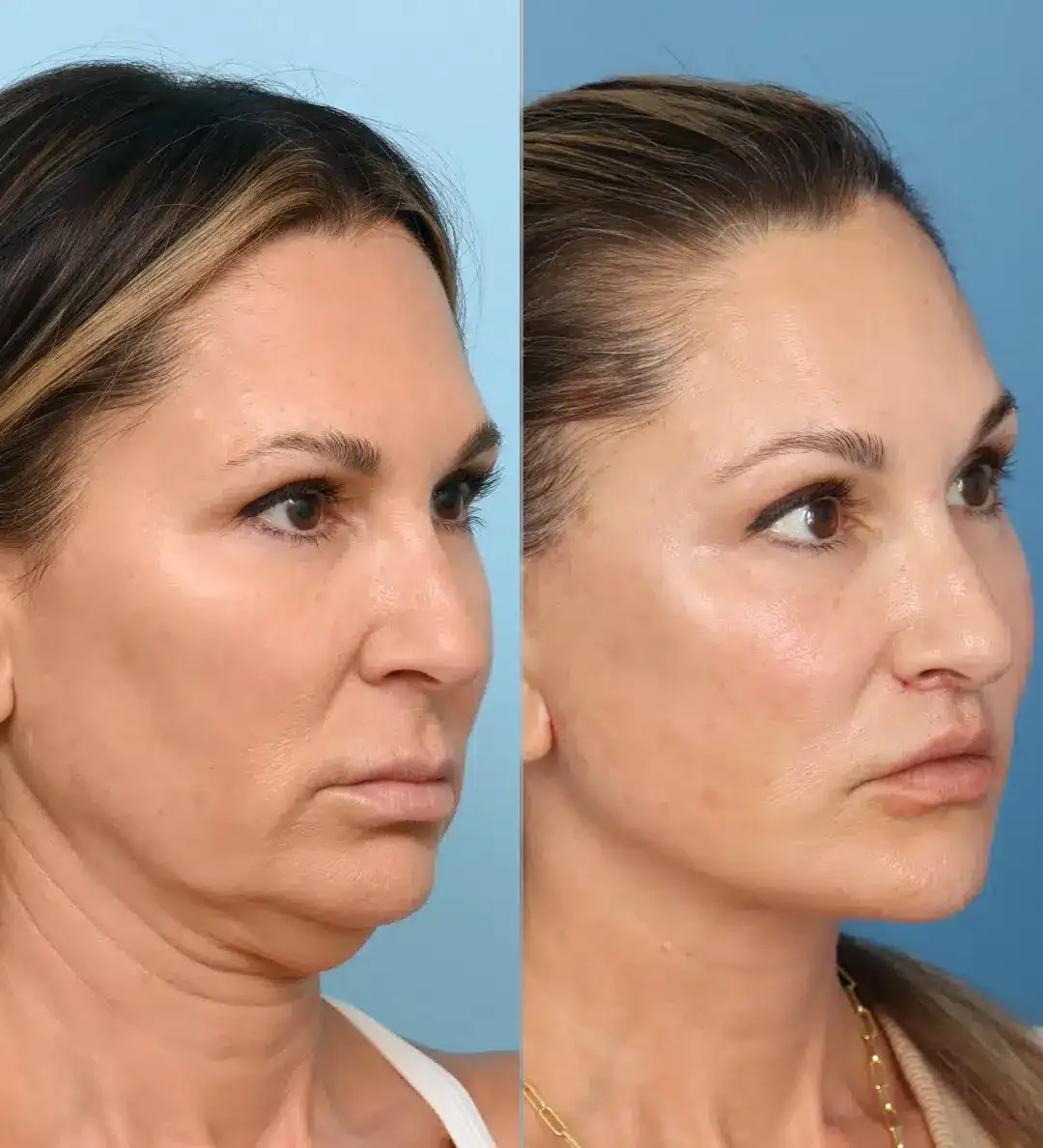 Antes e depois de lifting facial deep plane em Brasília, contorno da mandíbula e pescoço em três quartos — Dr. Thiago Perfeito