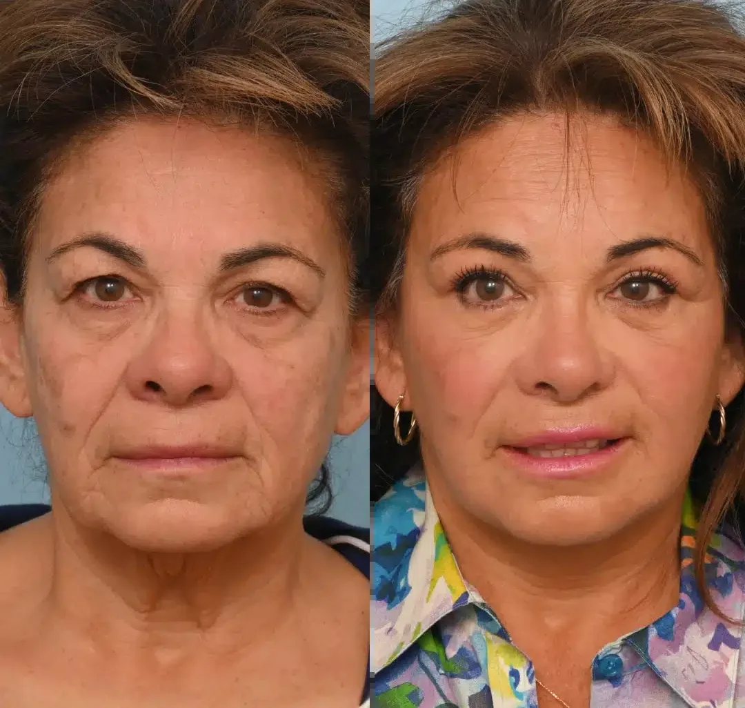 Antes e depois de lifting facial deep plane em Brasília, rosto de frente — Dr. Thiago Perfeito