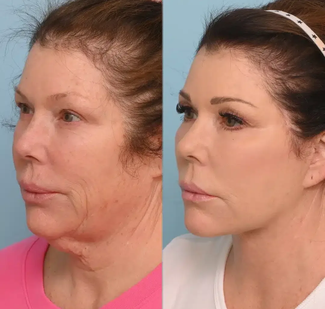 Antes e depois de lifting facial deep plane em Brasília, rosto em três quartos — Dr. Thiago Perfeito