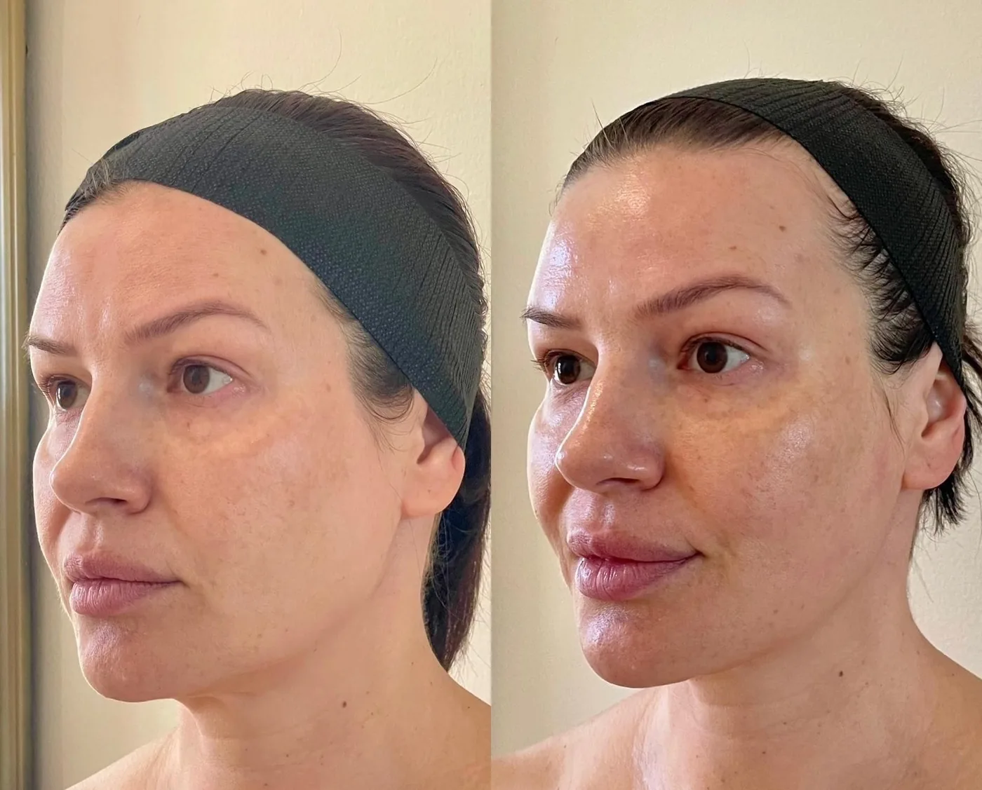 Antes e depois de Linear Z em Brasília — Dr. Thiago Perfeito