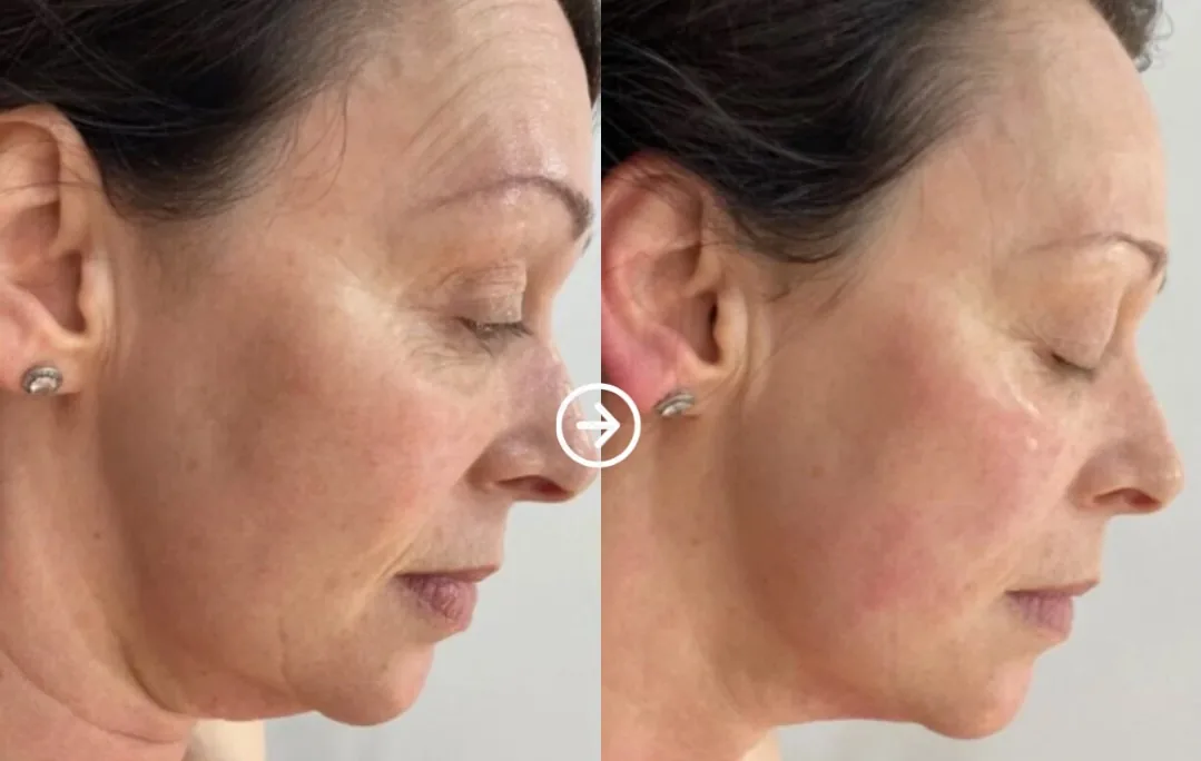 Antes e depois de Linear Z no contorno do rosto e da mandíbula em Brasília — Dr. Thiago Perfeito
