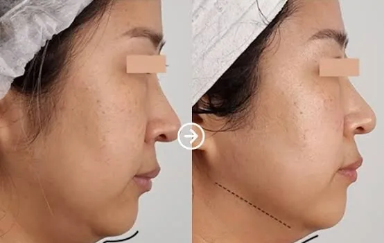 Antes e depois de Linear Z no contorno da mandíbula em Brasília — Dr. Thiago Perfeito