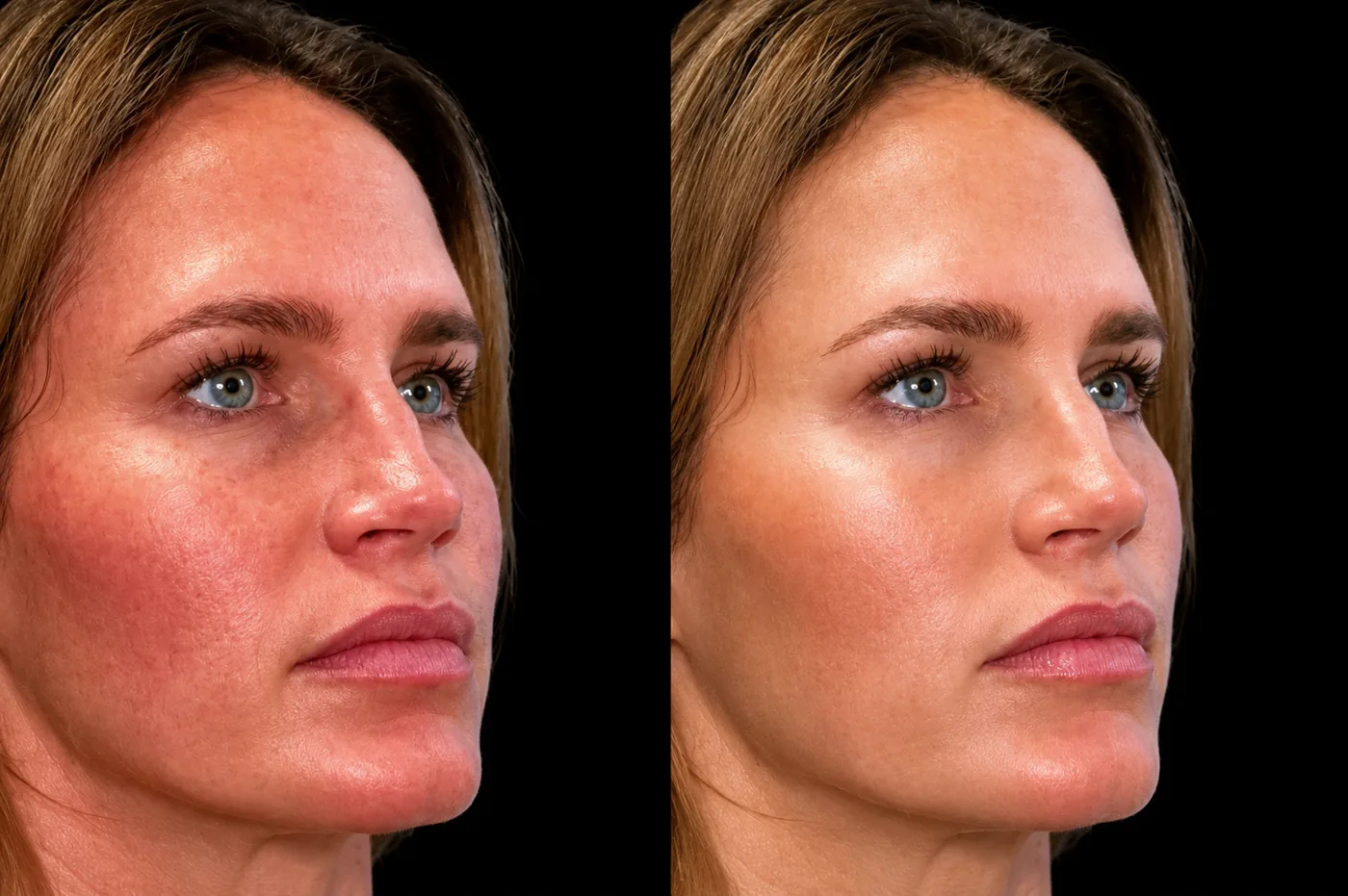 Antes e depois de Lipocube no rosto em Brasília: pele mais uniforme e menos avermelhada — Dr. Thiago Perfeito