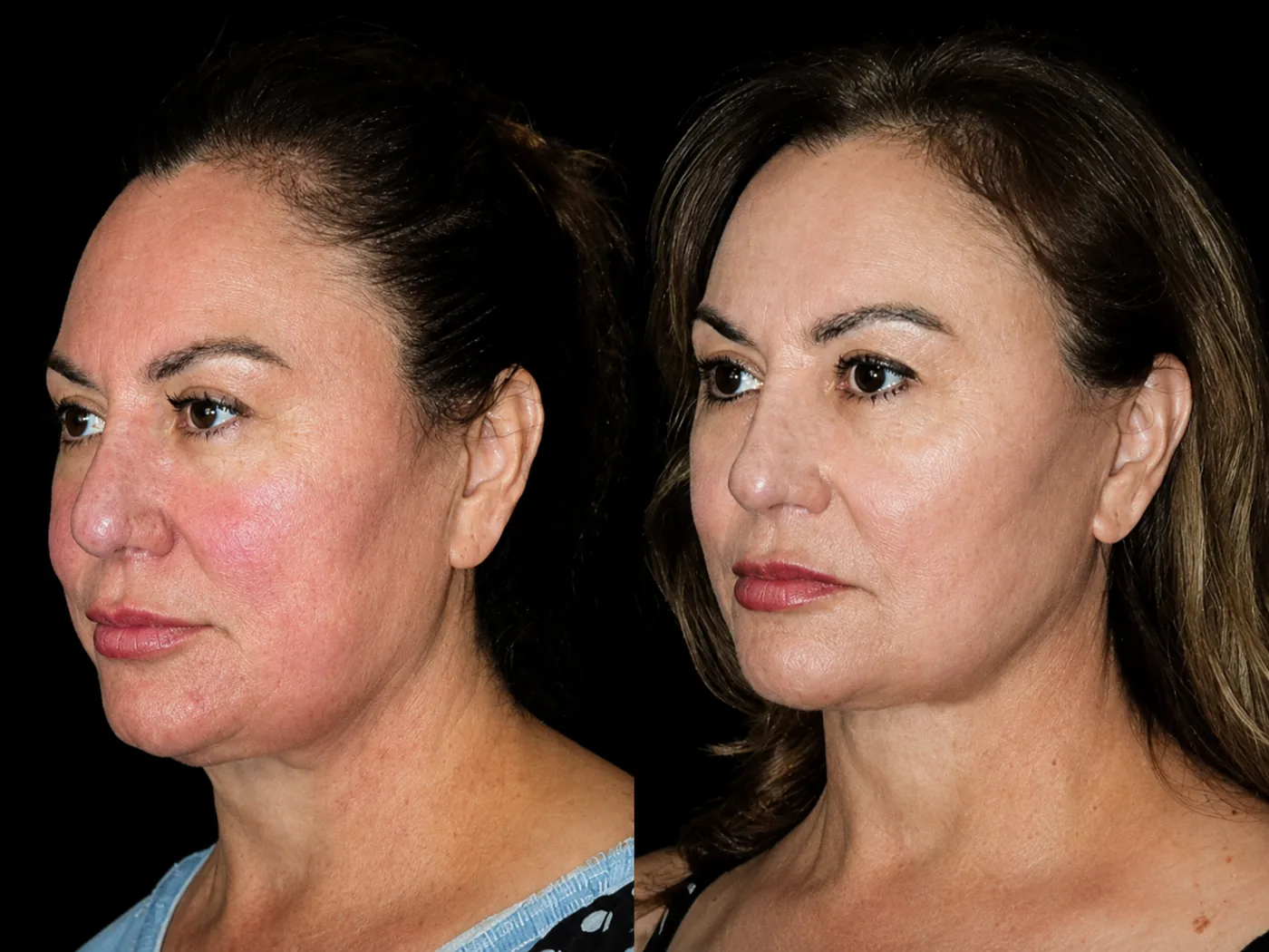 Antes e depois de Lipocube no rosto em Brasília: pele menos avermelhada e contorno mais definido — Dr. Thiago Perfeito