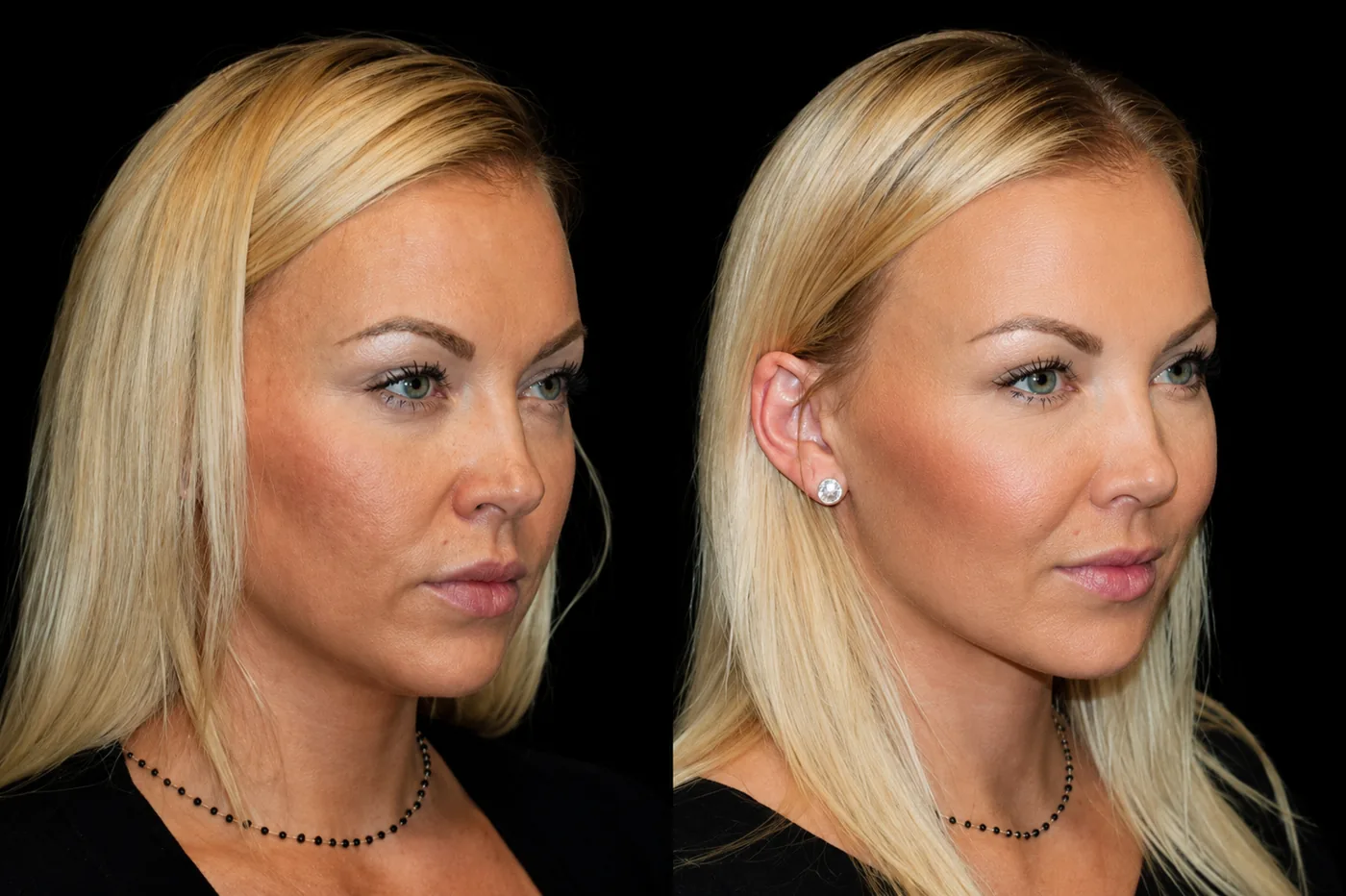 Antes e depois de Lipocube, enxertia de gordura no rosto com bochechas mais cheias — Dr. Thiago Perfeito