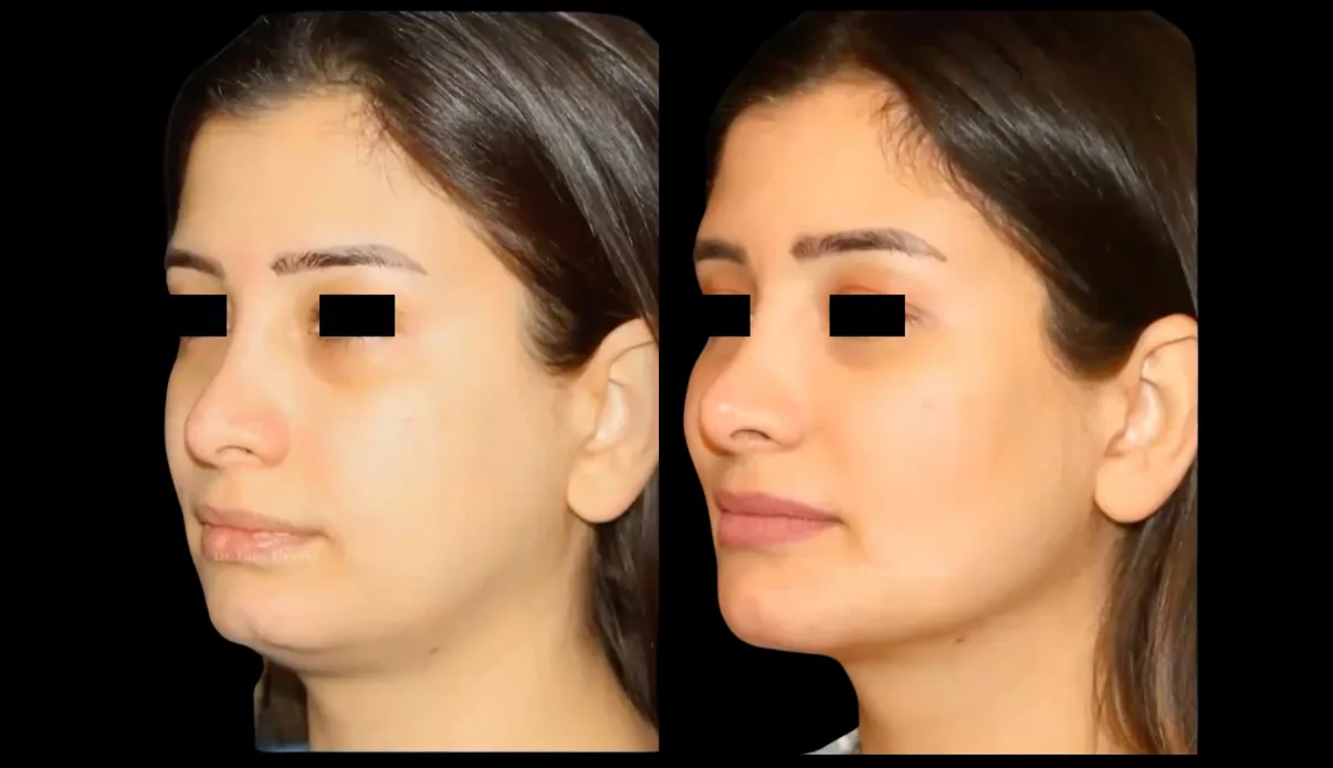 Antes e depois de Lipocube no rosto e na papada em Brasília — Dr. Thiago Perfeito