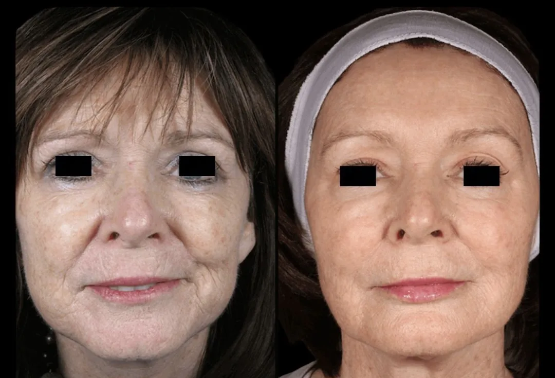 Antes e depois de Lipocube no rosto em Brasília: rugas e manchas atenuadas — Dr. Thiago Perfeito