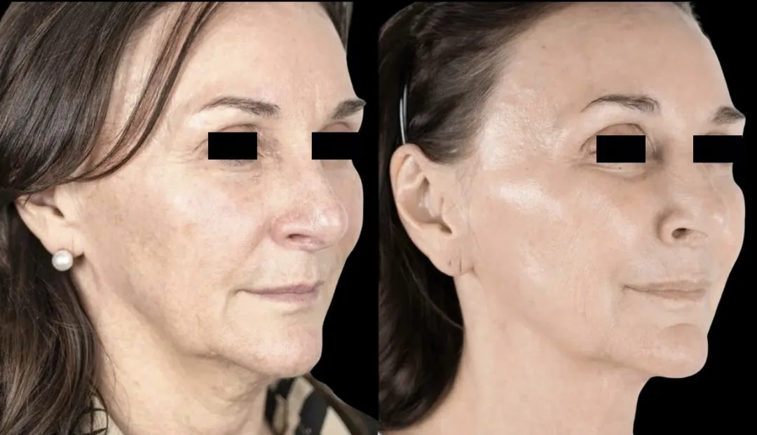 Antes e depois de Lipocube no rosto em Brasília: pele mais lisa e luminosa — Dr. Thiago Perfeito