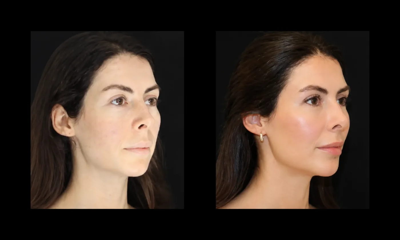Antes e depois de Lipocube no rosto, bochechas e contorno mais cheios e definidos — Dr. Thiago Perfeito