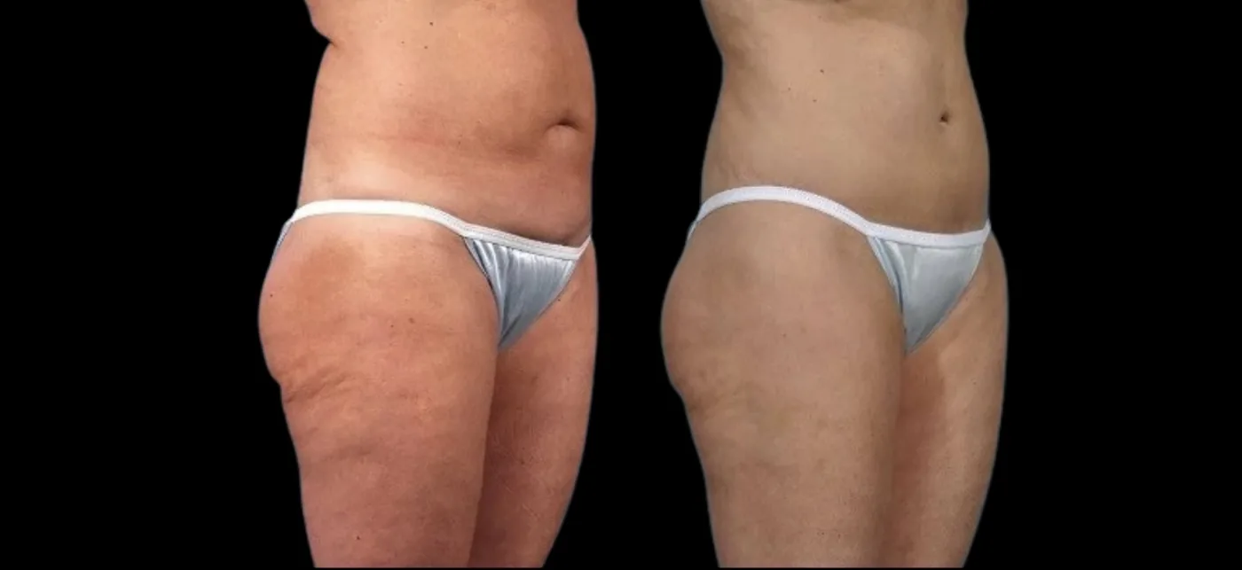 Antes e depois de Morpheus8 no abdome, no quadril e na coxa em Brasília, com contorno mais firme — Dr. Thiago Perfeito