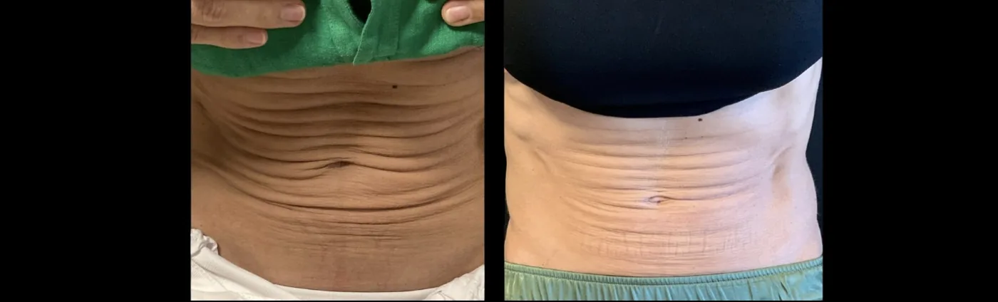 Antes e depois de Morpheus8 no abdome em Brasília, pele bem mais lisa — Dr. Thiago Perfeito