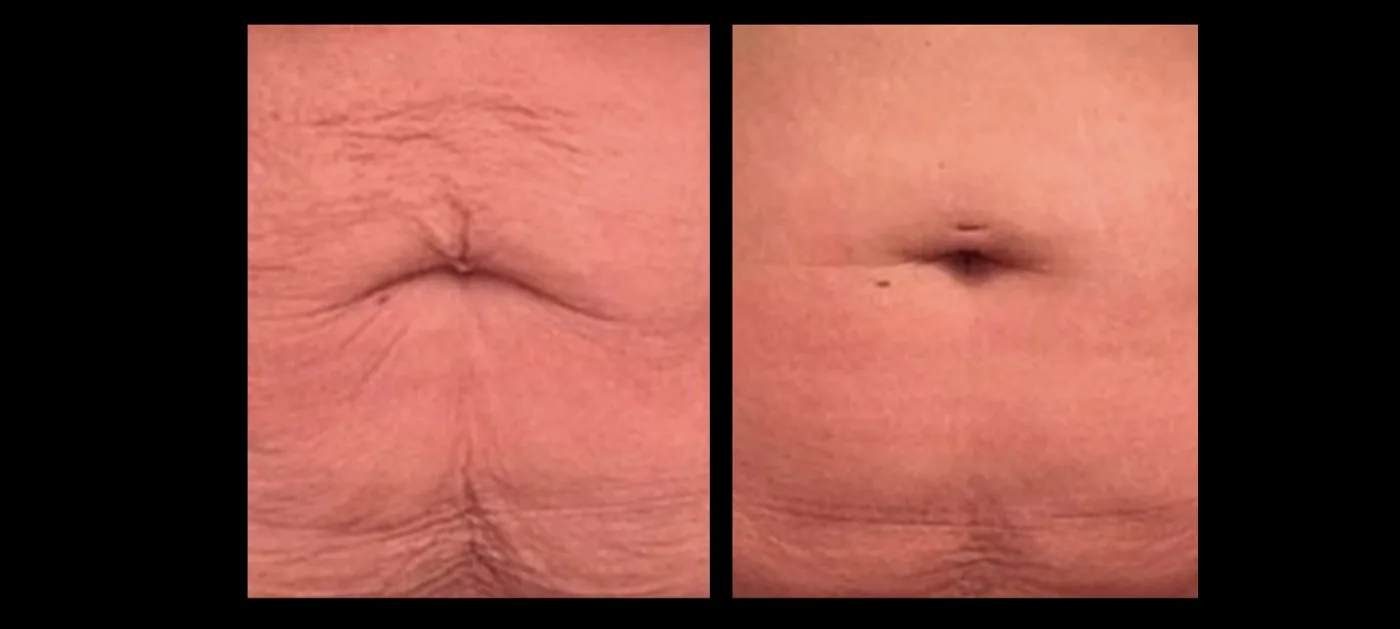 Antes e depois de Morpheus8 no abdome em Brasília: pele enrugada ao redor do umbigo mais lisa — Dr. Thiago Perfeito