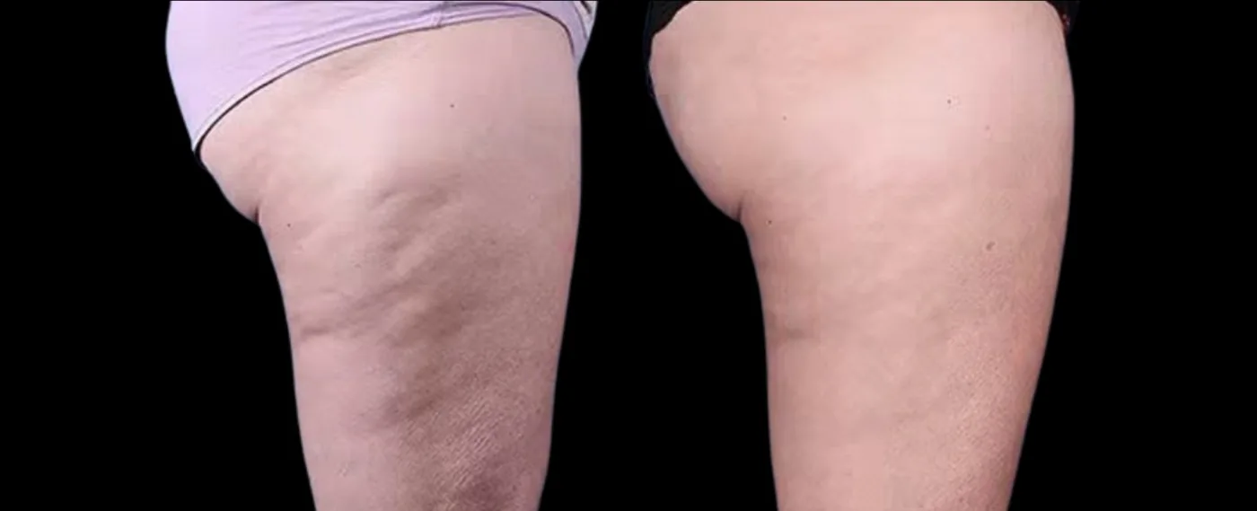 Antes e depois de Morpheus8 na coxa em Brasília — Dr. Thiago Perfeito