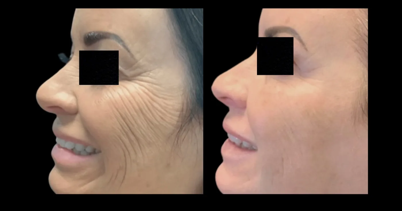Antes e depois de Morpheus8 nas rugas ao redor dos olhos em Brasília — Dr. Thiago Perfeito