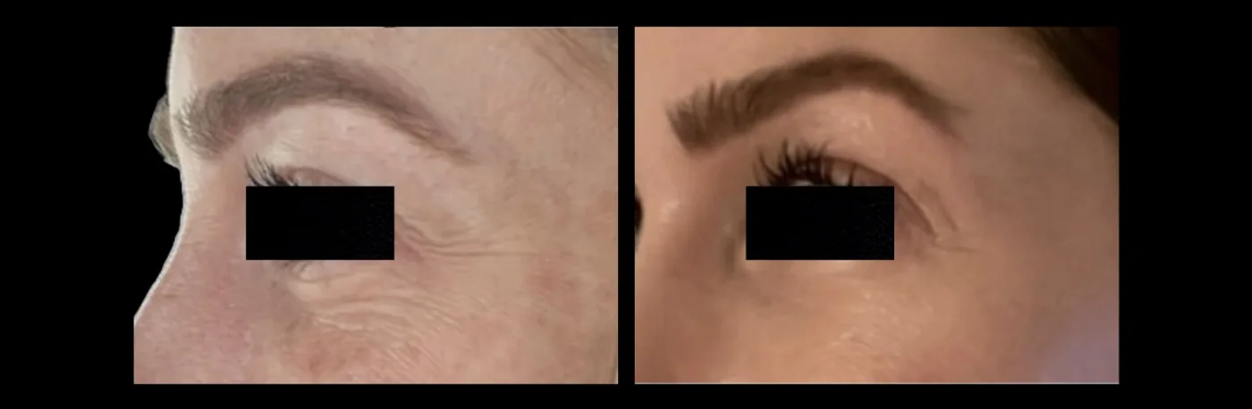 Antes e depois de Morpheus8 periorbital: rugas e pele fina da pálpebra inferior atenuadas — Dr. Thiago Perfeito, Brasília