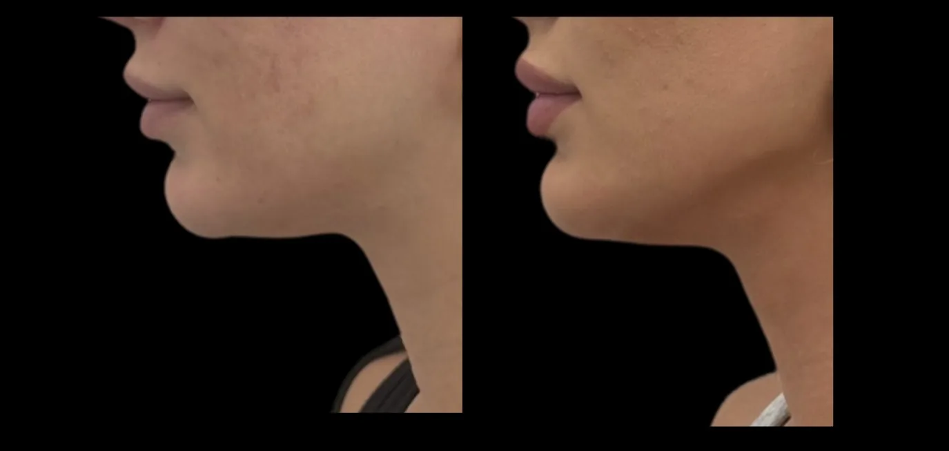 Antes e depois de Morpheus8 na linha da mandíbula em Brasília — Dr. Thiago Perfeito