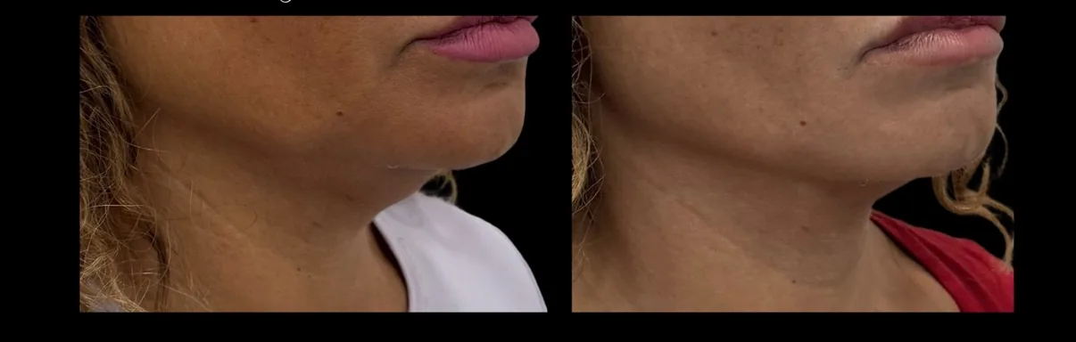 Antes e depois de Morpheus8 no contorno do queixo e do pescoço em Brasília — Dr. Thiago Perfeito