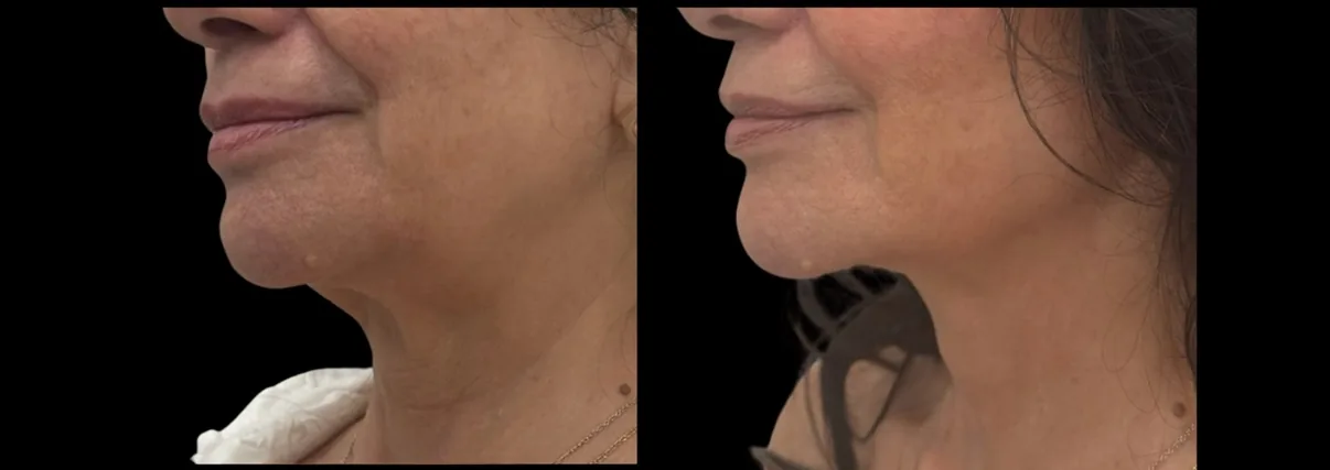 Antes e depois de Morpheus8 na mandíbula e no pescoço em Brasília — Dr. Thiago Perfeito