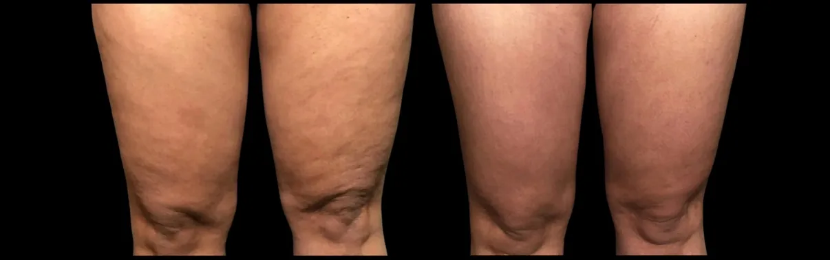 Antes e depois de Morpheus8 nas coxas em Brasília, pele mais lisa — Dr. Thiago Perfeito