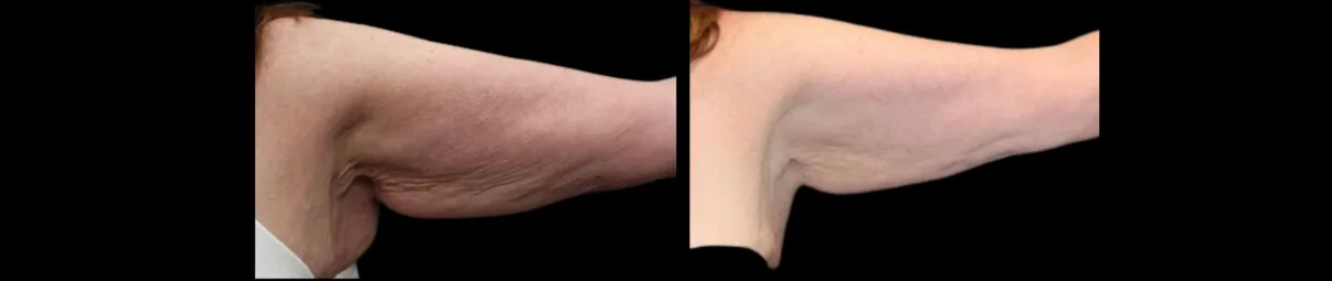 Antes e depois de Morpheus8 na face interna do braço em Brasília, pele mais firme — Dr. Thiago Perfeito