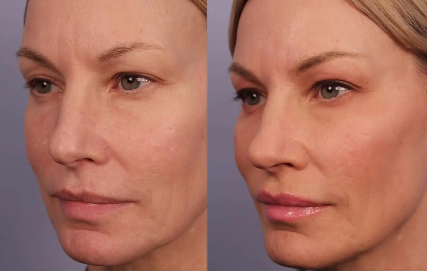 Antes e depois de Morpheus8 no rosto em Brasília — Dr. Thiago Perfeito