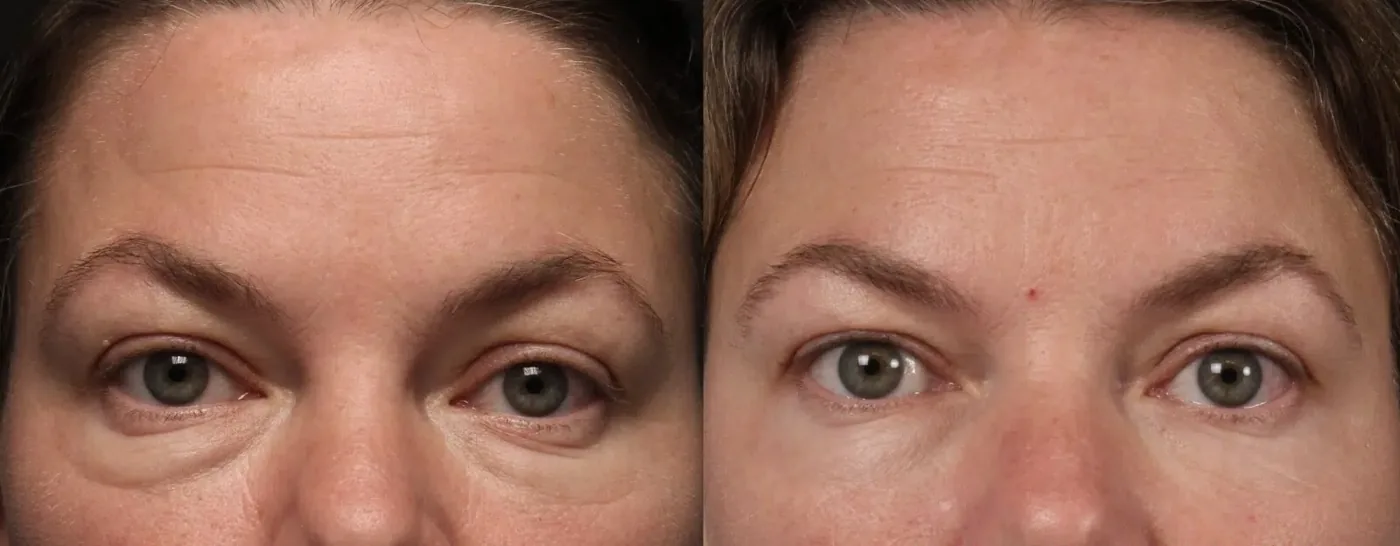 Antes e depois de Morpheus8 na região dos olhos, com bolsas e olheiras da pálpebra inferior atenuadas — Dr. Thiago Perfeito, Brasília