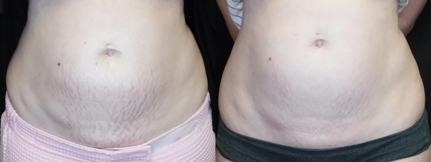 Antes e depois de Morpheus8 em estrias do abdome em Brasília — Dr. Thiago Perfeito