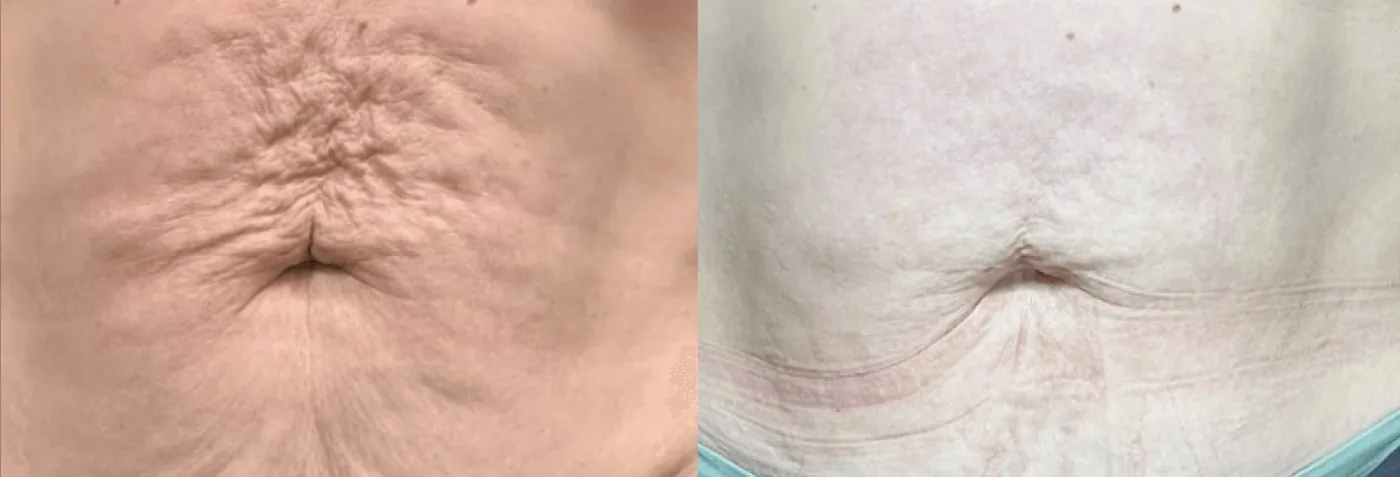 Antes e depois de Morpheus8 no abdome em Brasília: pele enrugada da barriga mais lisa e firme — Dr. Thiago Perfeito