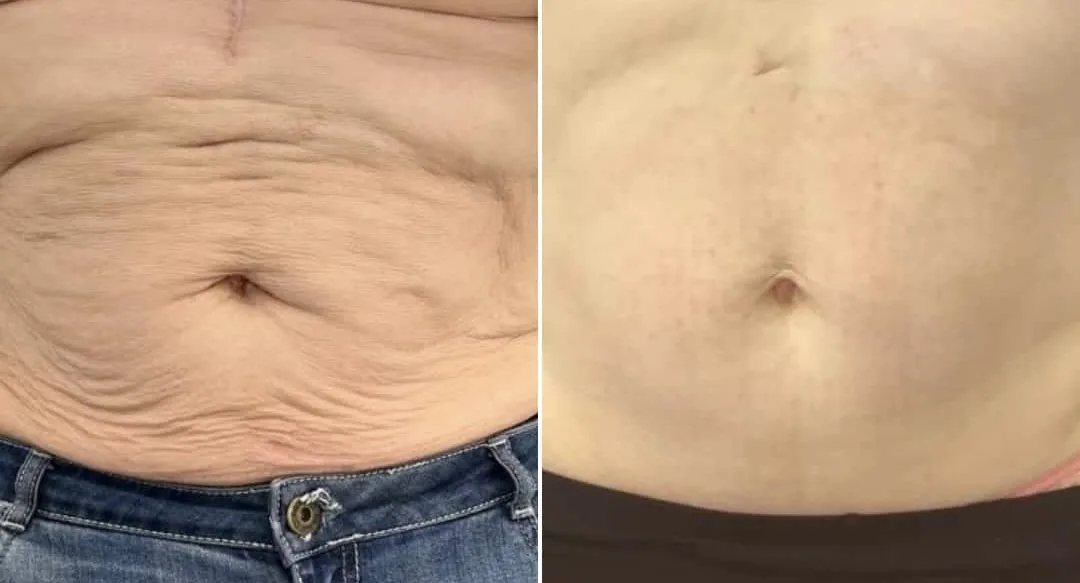 Antes e depois de Morpheus8 no abdome com flacidez e enrugamento em Brasília — Dr. Thiago Perfeito
