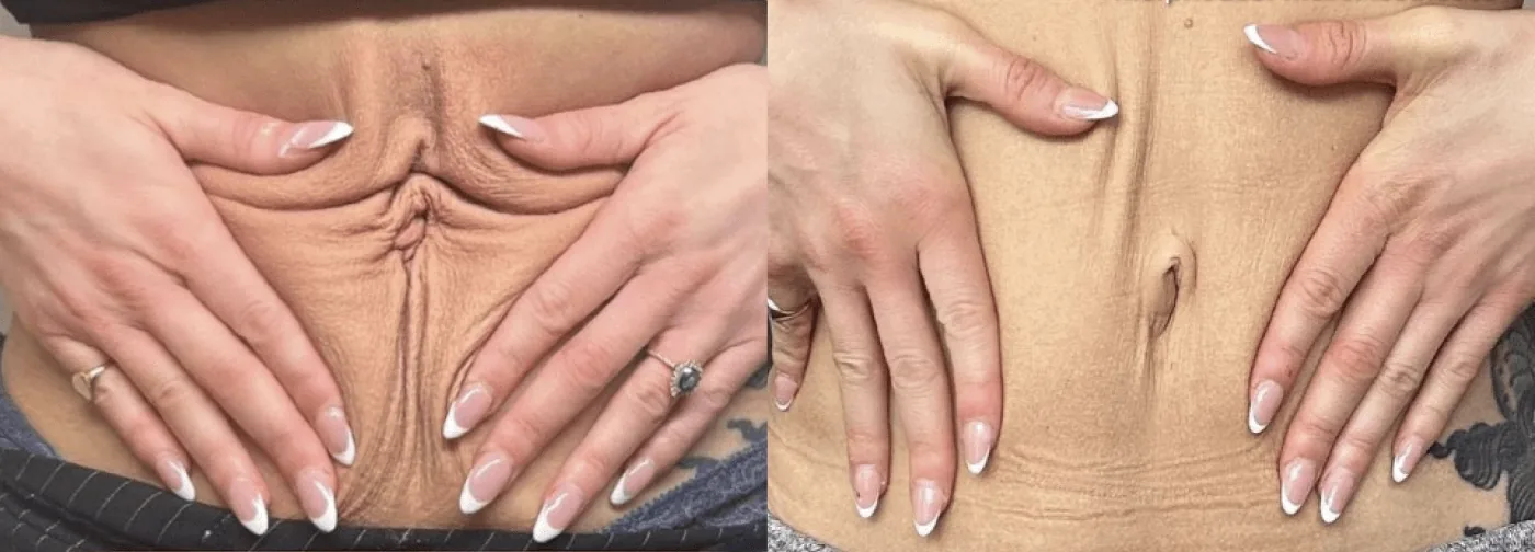 Antes e depois de Morpheus8 no abdome em Brasília: dobras e flacidez da pele reduzidas — Dr. Thiago Perfeito