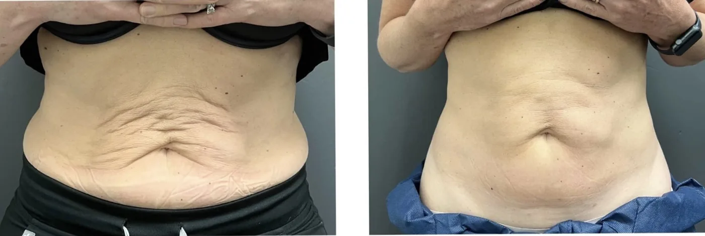 Antes e depois de Morpheus8 no abdome com flacidez e enrugamento em Brasília — Dr. Thiago Perfeito