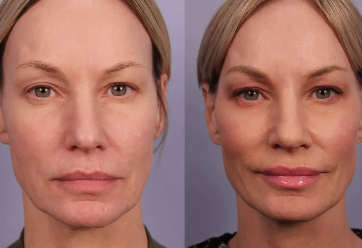Antes e depois de Morpheus8 no rosto em Brasília — Dr. Thiago Perfeito
