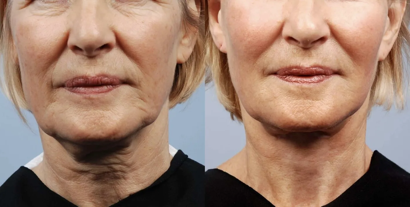 Antes e depois de Morpheus8 na mandíbula e no pescoço em Brasília — Dr. Thiago Perfeito