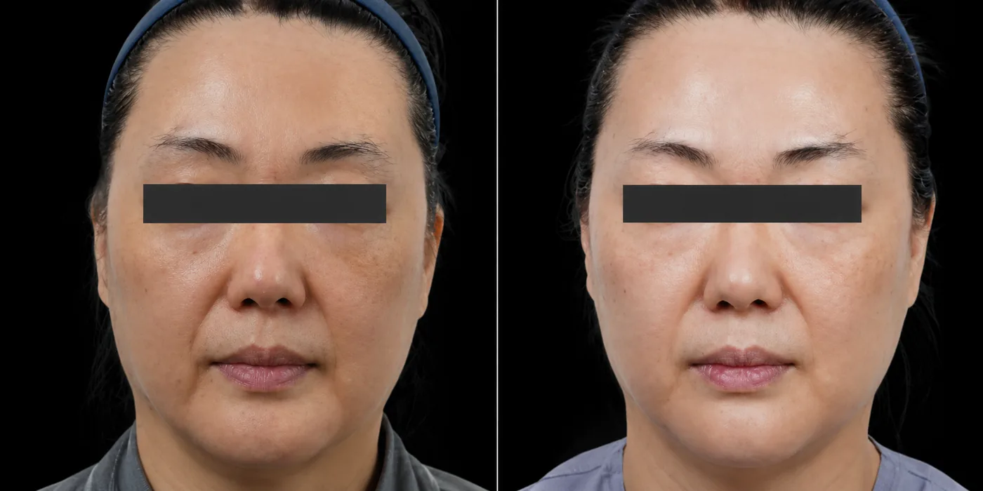 Antes e depois de Ultraformer MPT no rosto em Brasília — Dr. Thiago Perfeito