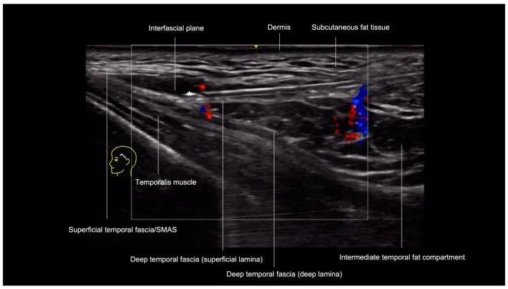 Ultrassom Doppler da têmpora — cânula no plano interfascial — Dr. Thiago Perfeito