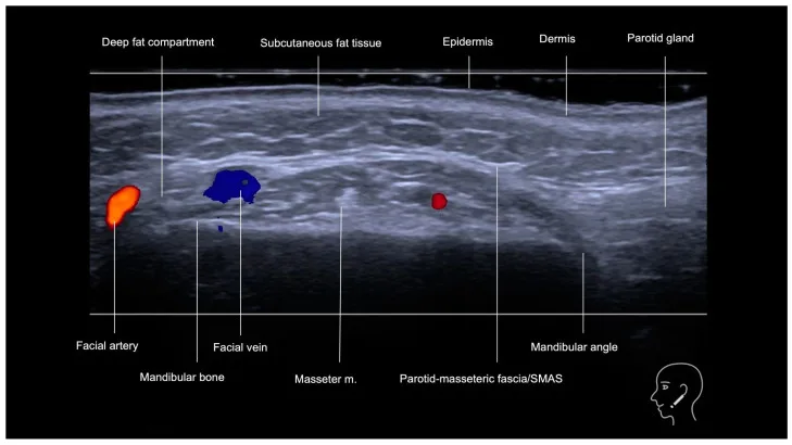 Ultrassom Doppler da região mandibular — artéria e veia facial à frente do masseter — Dr. Thiago Perfeito