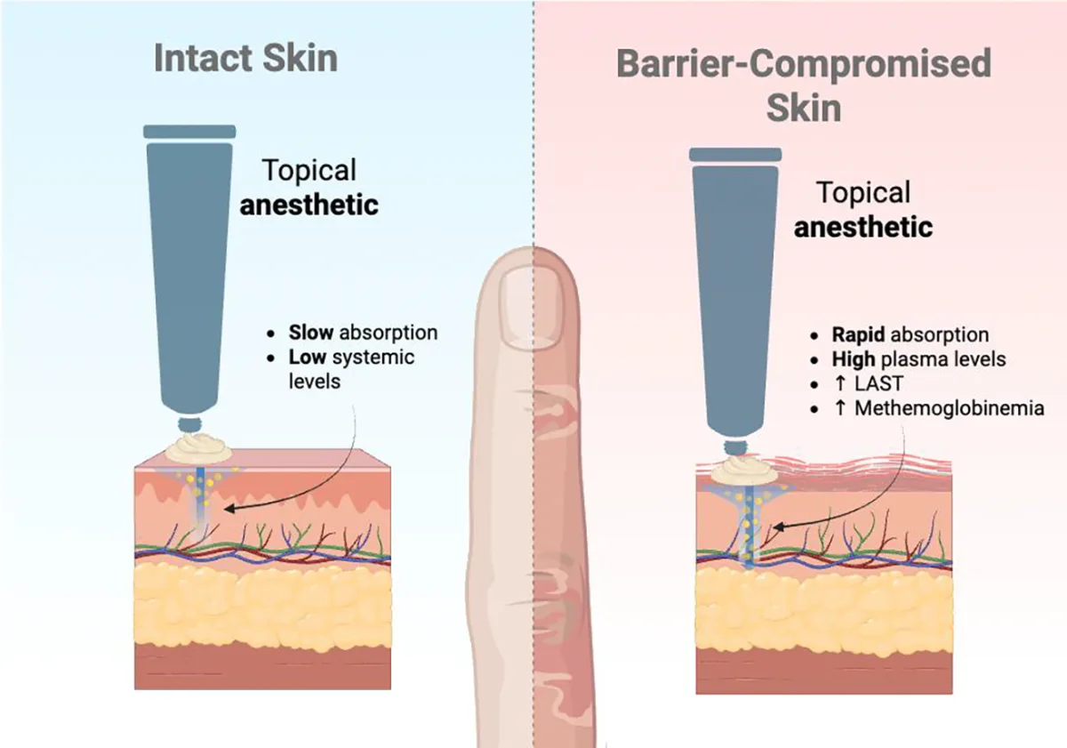 Esquema da absorção de anestésico tópico em pele intacta e em pele com barreira rompida — Dr. Thiago Perfeito