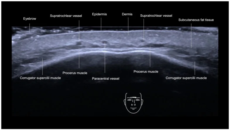 Ultrassom transversal da glabela com vasos supratrocleares e paracentral — figura de estudo — Dr. Thiago Perfeito